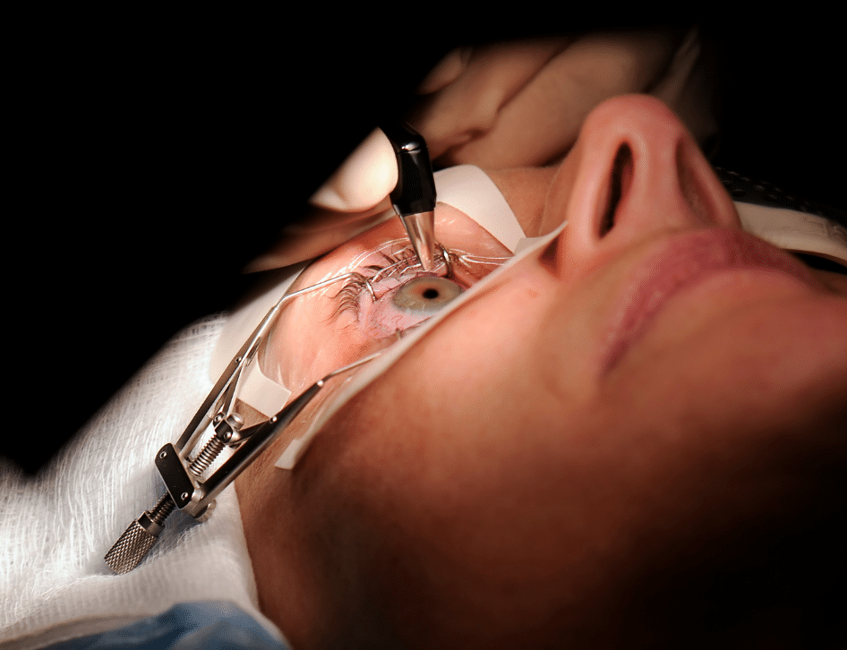 Lasik