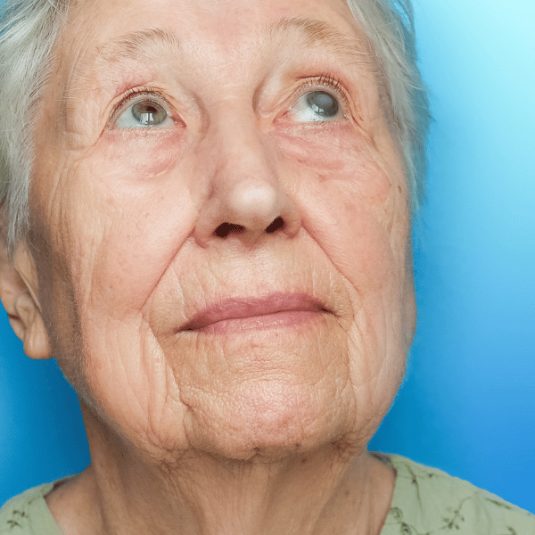 cirurgia de catarata pode reduzir o risco de Alzheimer