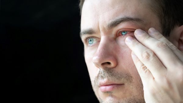 Homem mostrando um dos olhos que está avermelhado, um dos sintomas da ceratite.