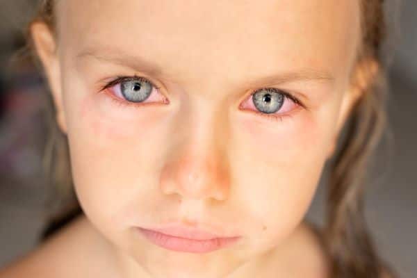 Menina com os olhos vermelhos - sintoma da conjuntivite.