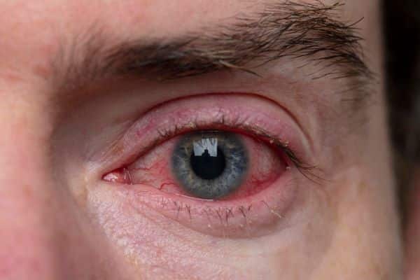 Homem com sintoma de conjuntivite viral