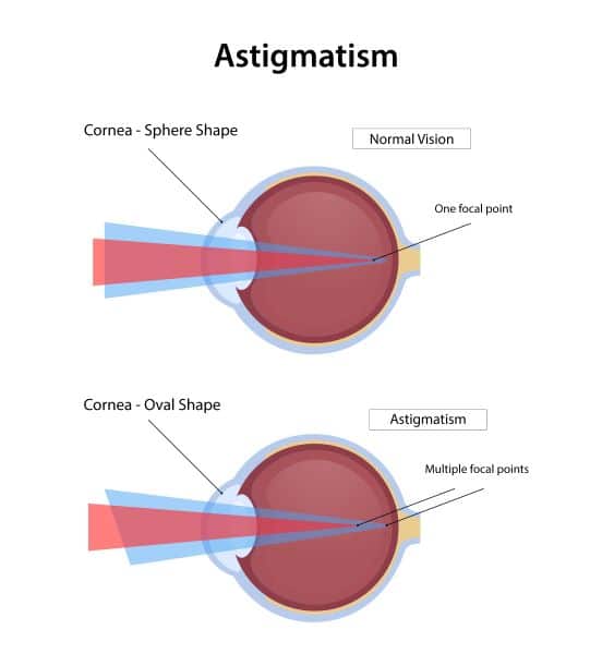 Gravura explicando como acontece uma das condições oculares que prejudica a visão, o astigmatismo.