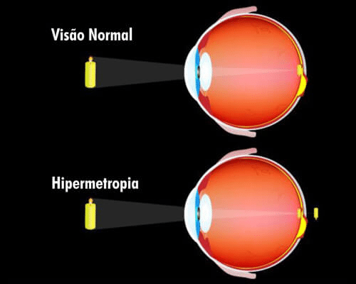 Quadro comparativo de como é a visão normal de uma pessoa e como é a de um hipermetrope. 