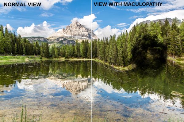 Uma visão de tela dividida  mostrando a imagem de um lago cênico e uma grande montanha nos Alpes. Exemplo da visão de uma pessoa com retinopatia diabética ou sem a doença. A mancha escura demostra maculopatia no campo de visão.
