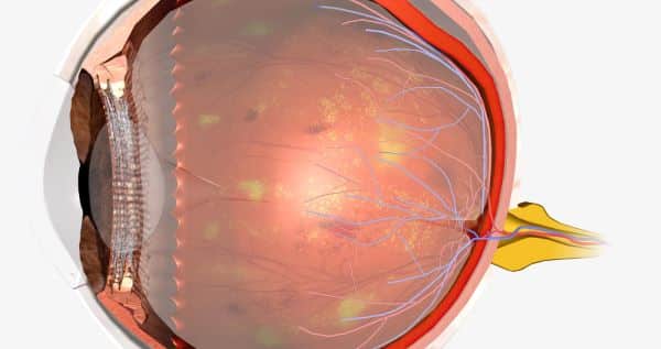 As retinopatias são complicações que afetam os olhos.