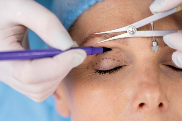 Médico marca a distância entre as sobrancelhas e a pálpebra de paciente para realizar uma blefaroplastia.