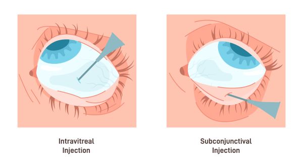 Injeção intravítrea para tratar a degeneração macular relacionada à idade.
