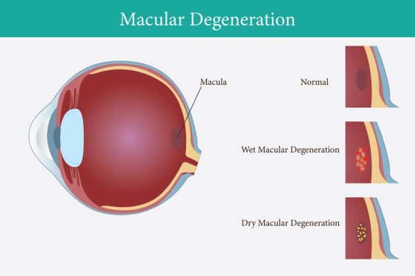 Painel mostrando a anatomia do olho que apresenta degeneração macular relacionada à idade.