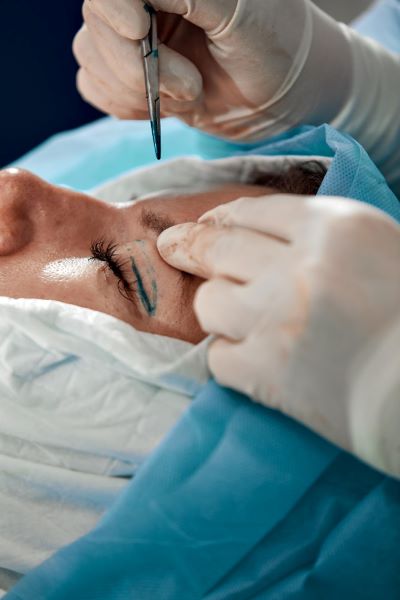 Cirurgião plástico dando início à cirurgia de pálpebras. Na imagem vê-se as mãos do médico com luvas brancas segurando o instrumento cirúrgico próximo à pálpebra da paciente.