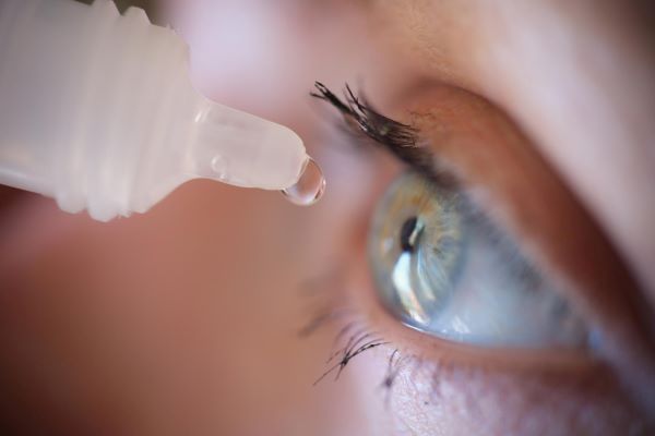 Mulher pingando gotas de colírio no olho azul para evitar olho seco após blefaroplastia.
