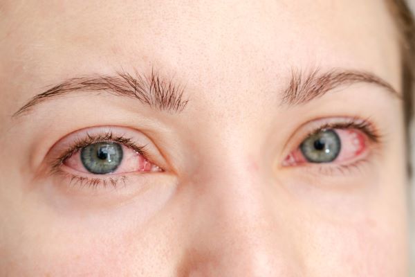 Jovem que apresenta olhos vermelhos devido à irritação pós-cirúrgica.