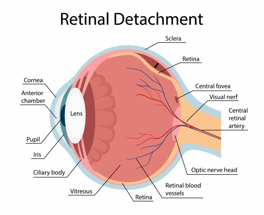 Vetor demonstrando Descolamento de Retina.