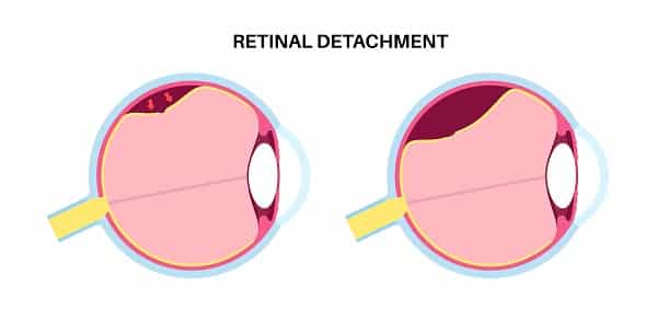 Vetor mostrando o Descolamento de Retina, uma das doenças retinianas.