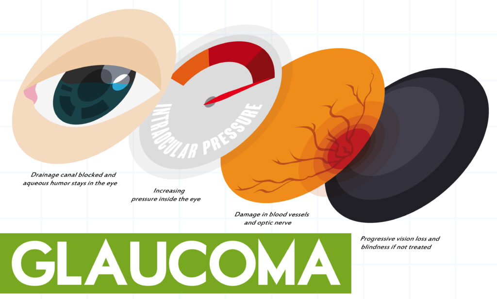 Infográfico do glaucoma demostrando como ocorre a progressão da doença.