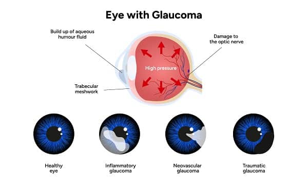 Imagem do globo ocular que apresenta glaucoma. 
Abaixo, em azul, imagens de olhos com diferentes tipos de glaucoma em comparativo com o olho normal.