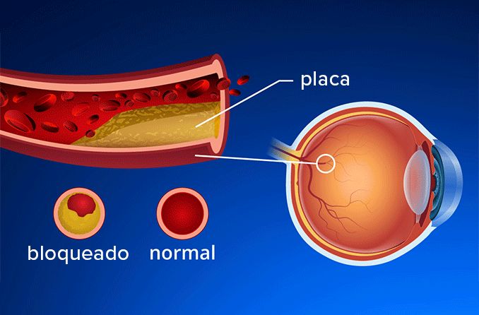 Imagem demostrativa de como a arteriosclerose bloqueia o fluxo sanguíneo.