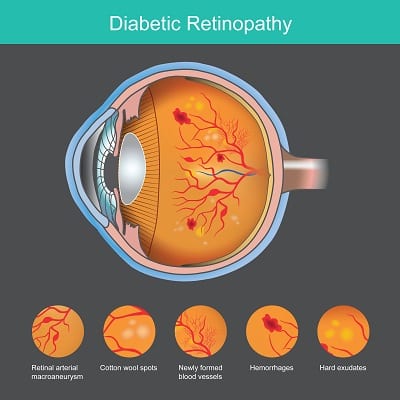 Retinopatia diabética - uma ilustração representativa da doença.