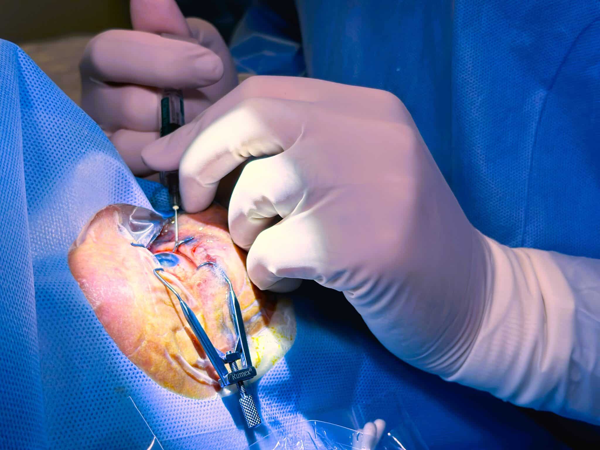 cirurgia-de-catarata-refrativa-oftalmologia-integrada.jpg (2)