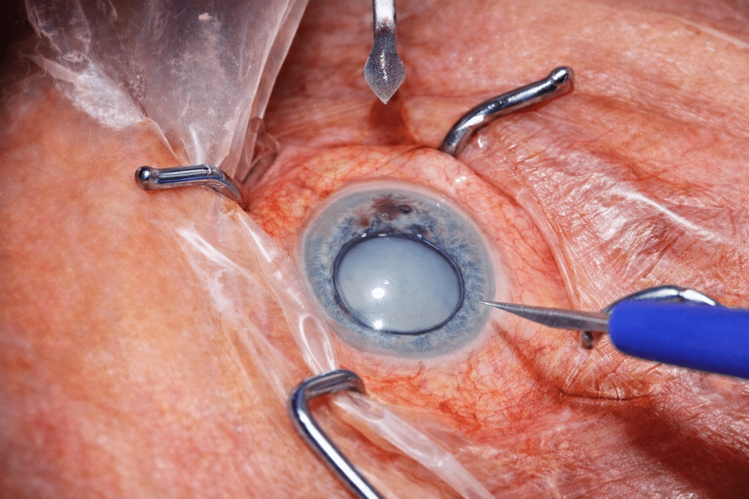 cirurgia-de-catarata-refrativa-oftalmologia-integrada.jpg (4)
