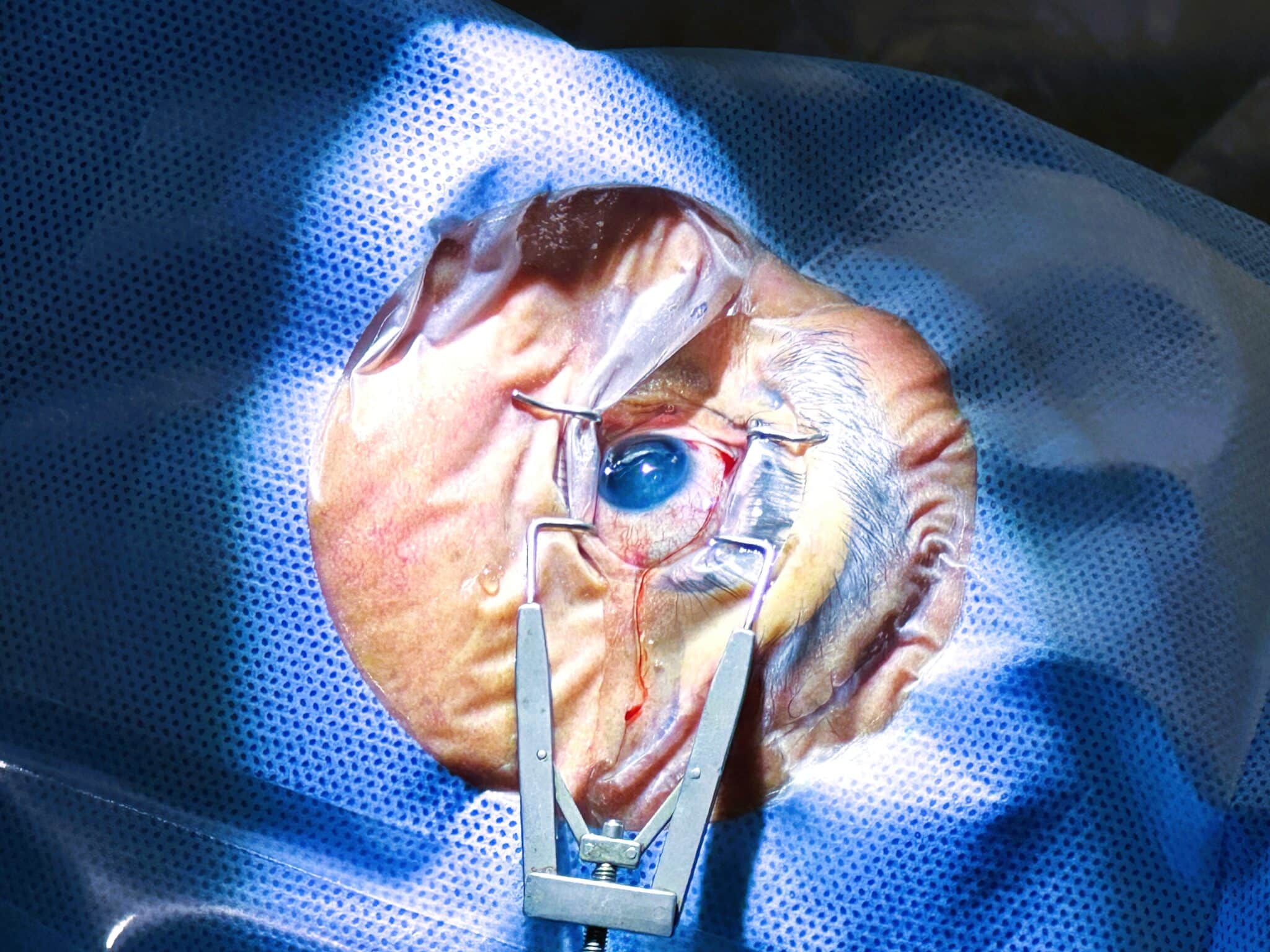 cirurgia-de-catarata-refrativa-oftalmologia-integrada.jpg (2)