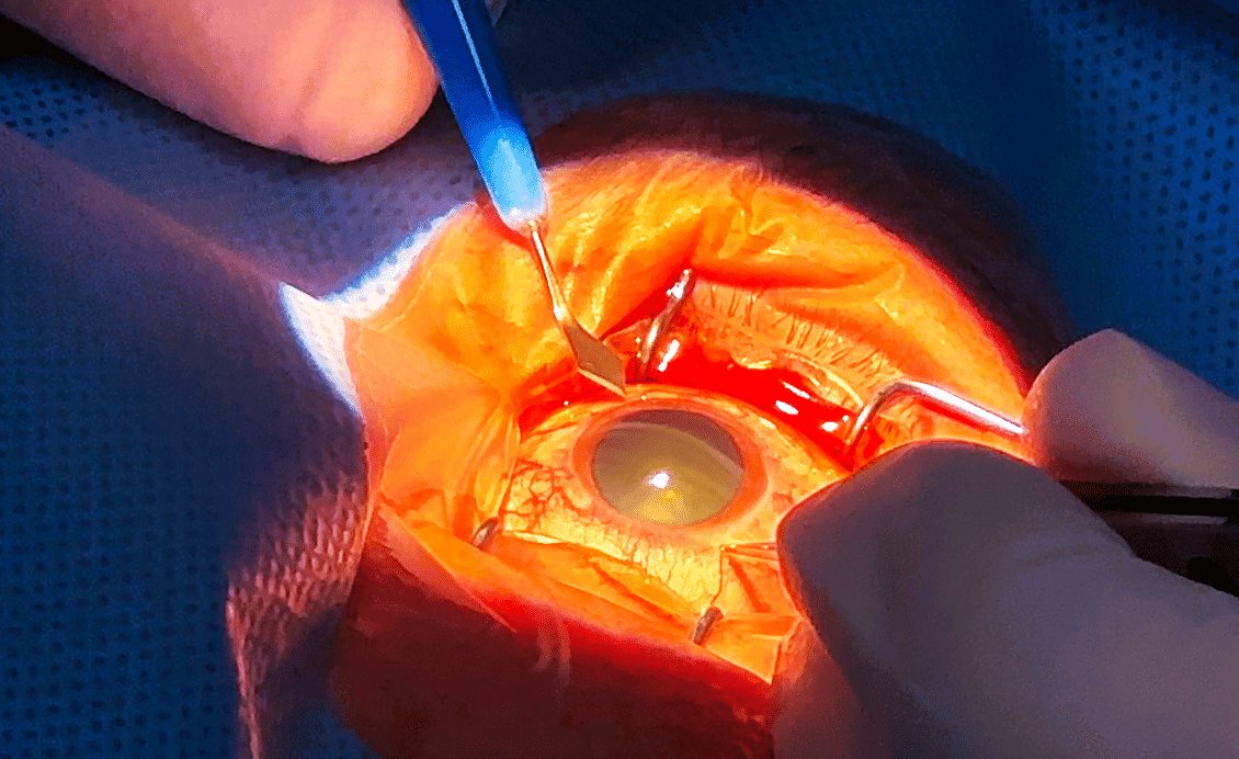 cirurgia-de-catarata-refrativa-oftalmologia-integrada.jpg
