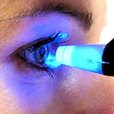 Exame de tonometria - close de um olho feminino sendo avaliado pelo oftalmologista. Um aparelho emite luz azul direcionada ao globo ocular.