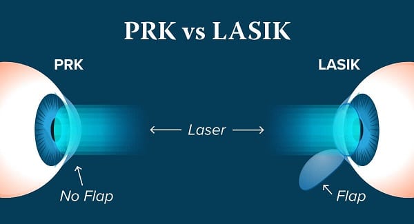 Dois tipos de cirurgias refrativas a laser: PRK e LASIK.