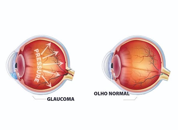 Imagem de um globo ocular normal e outro com pressão ocular elevada - levando ao diagnóstico de glaucoma.